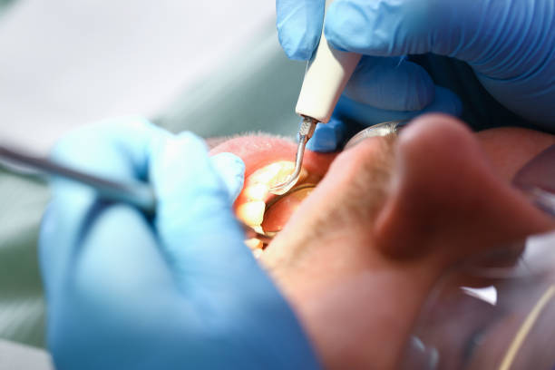 Best Emergency Root Canal Treatment in Vassar, MI
