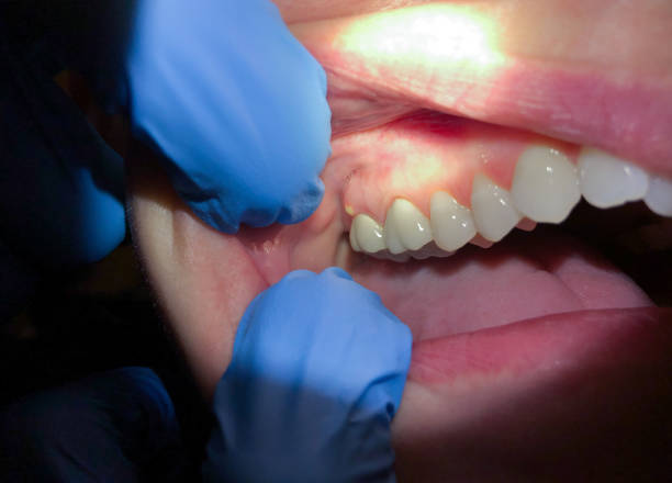 Best Emergency Dental Care for Abscessed Tooth in Vassar, MI