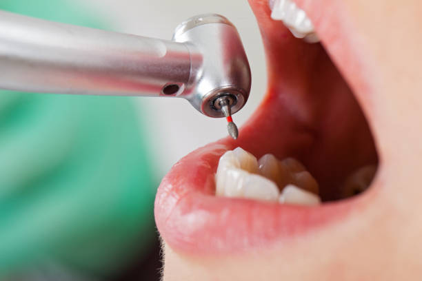 Best Emergency Dental Care for Abscessed Tooth in Vassar, MI